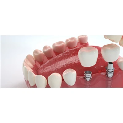Dilema Abutment: Ketepatan Disesuaikan atau Kesederhanaan Luar Rak?