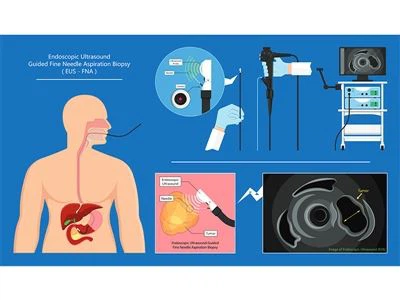 Mengapa anda memerlukan EUS selepas gastroskopi? Jawapan dari ahli gastroente...