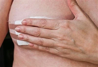 Biopsi jarum teras ultrasound dari payudara