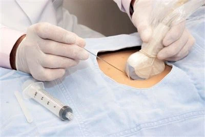 Biopsi Kanser Payudara: Risiko metastasis, jarum halus vs jarum teras, dan 11...