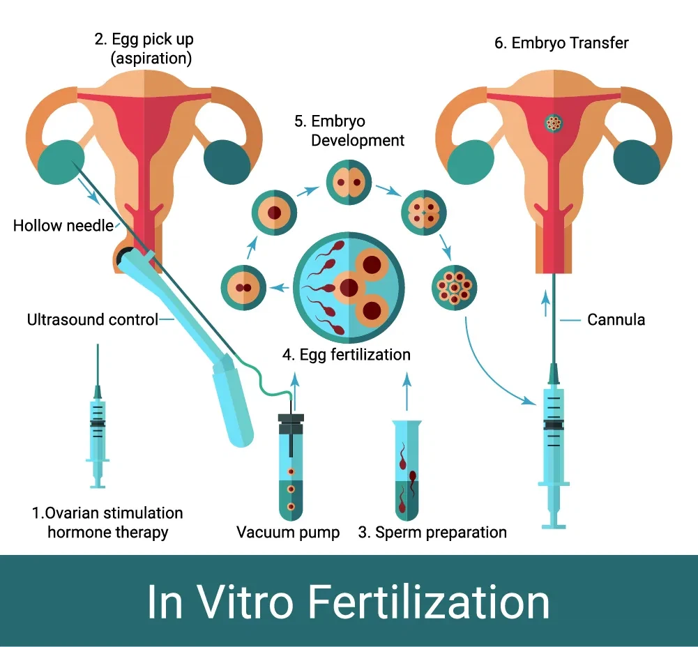 Keberkesanan pelbagai saiz jarum pengambilan telur dalam prosedur IVF