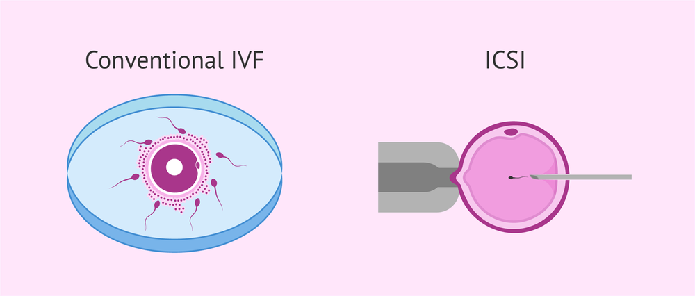 IVF (in vitro fertilization) IVF (in vitro fertilization)